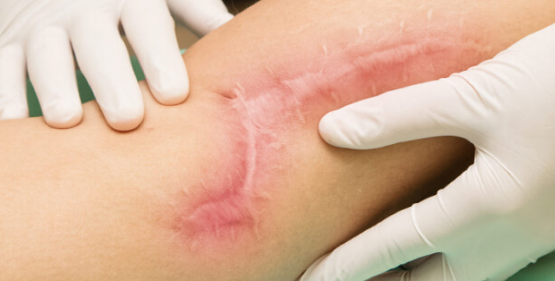 Narbenbehandlung